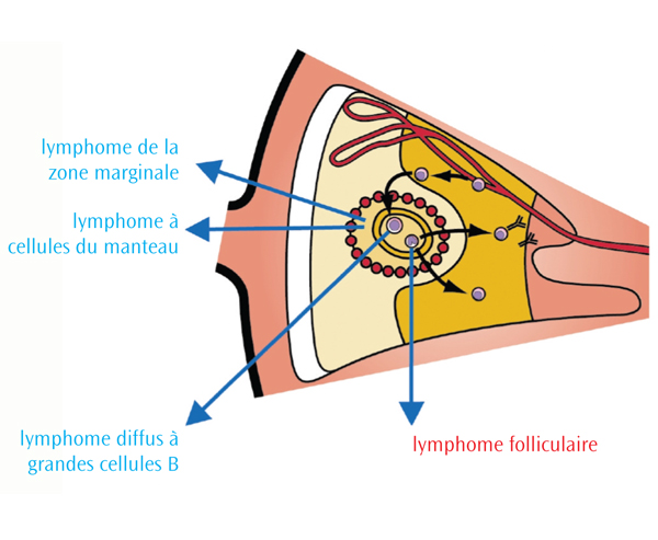 Le lymphome folliculaire