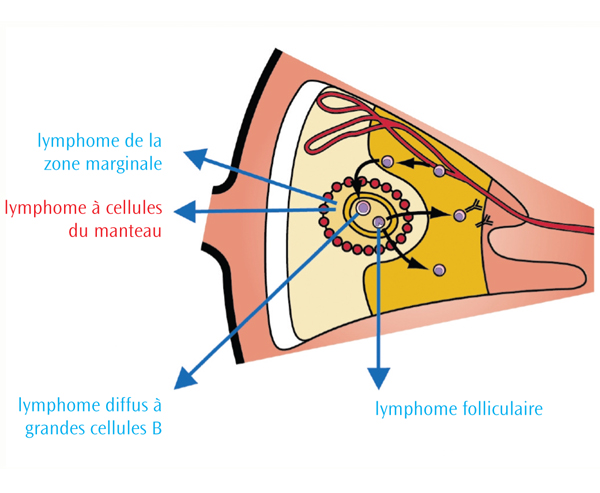 Le lymphome à cellules du manteau